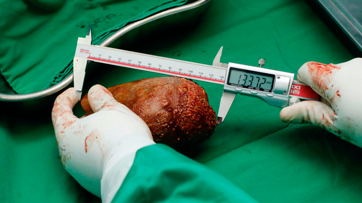 Extirpan el cálculo renal más grande y pesado del mundo